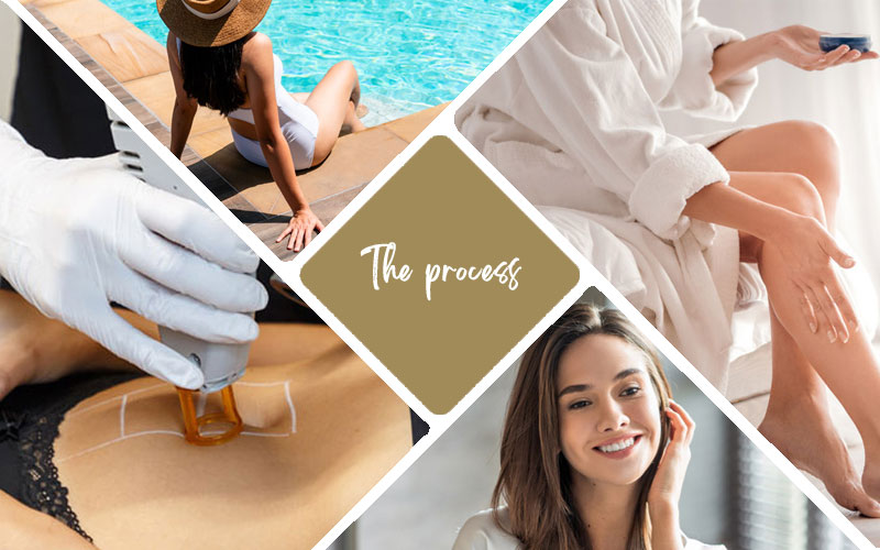 laser hair removal treatment process